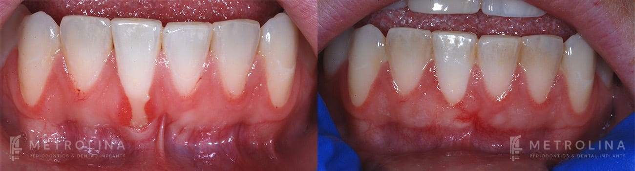 Connective Tissue Graft Before and After Patient 1.11