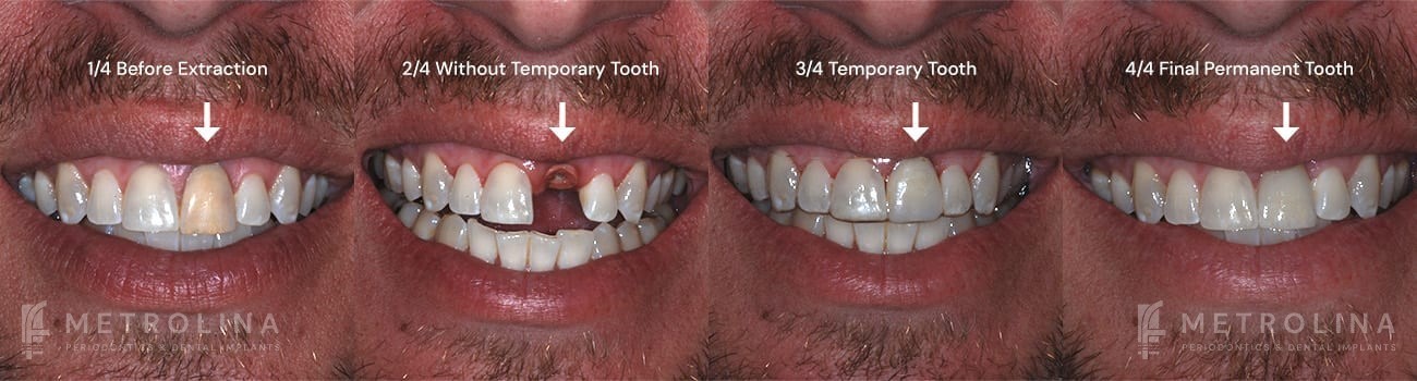 metrolina-periodontics-charlotte-dental-implants-patient-1-1
